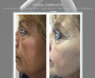 HIFU FACIAL