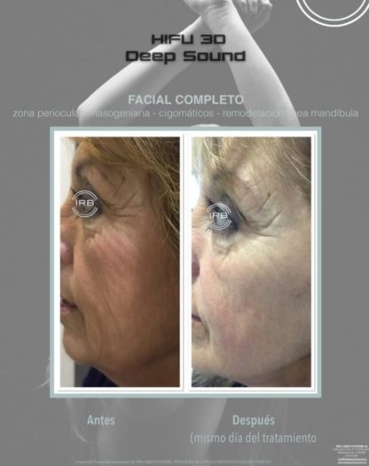 HIFU FACIAL