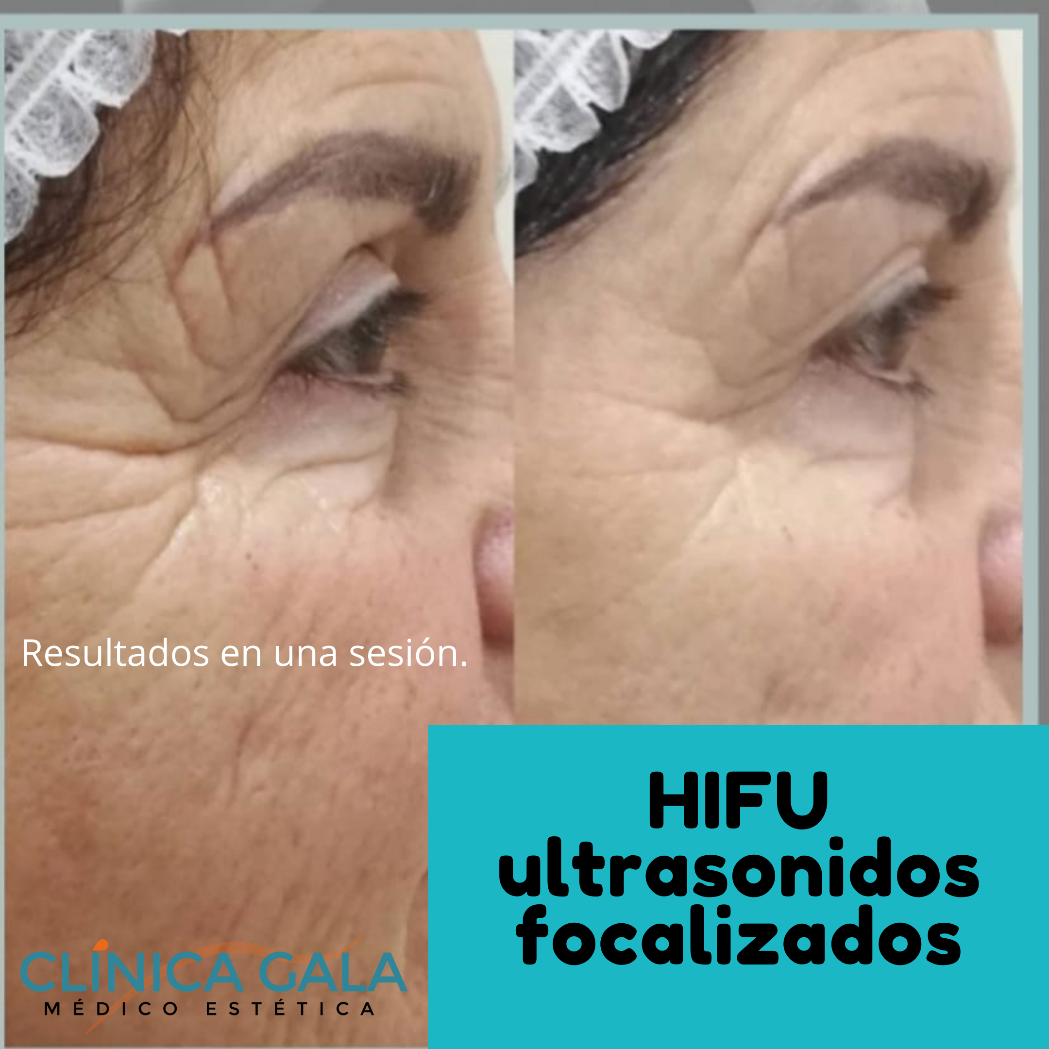 hifu facial