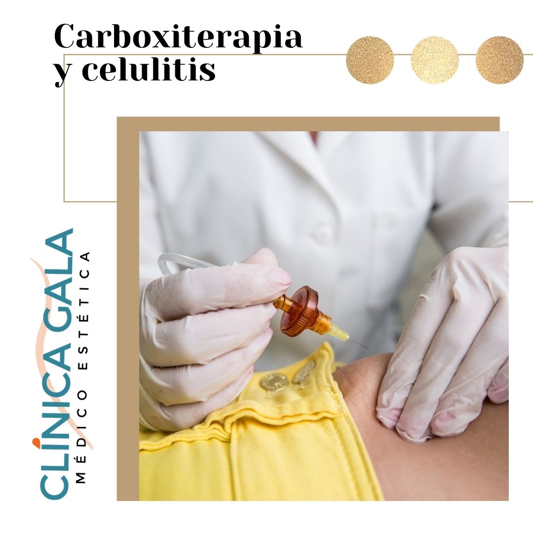 carboxiterapia y celulitis