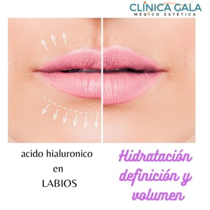 relleno labios
