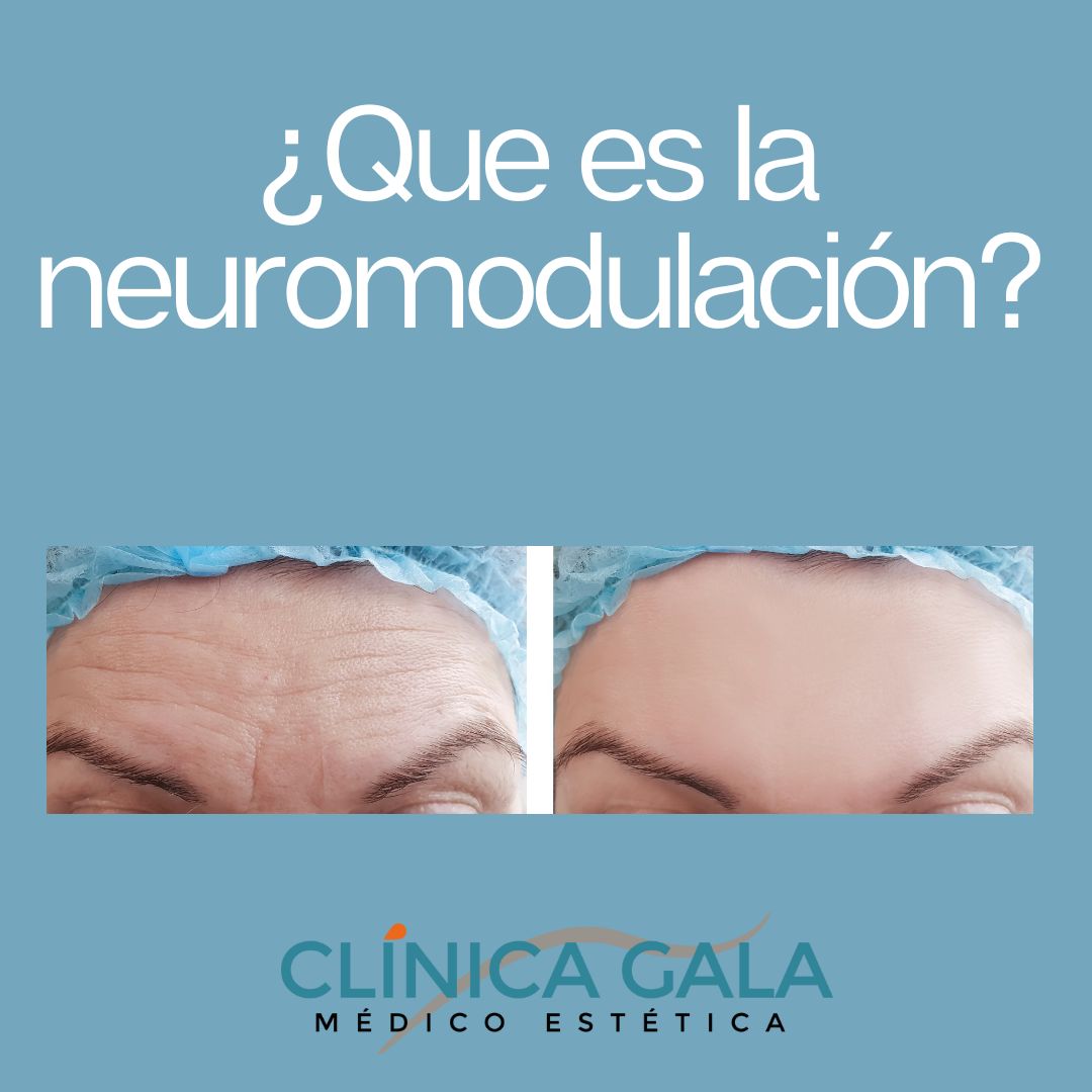 neuromodulación